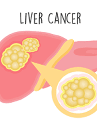 Cancer - Liver Cancer
