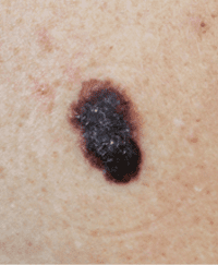 Cancer - Skin Cancer