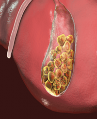 Gall Bladder and Gall Stones