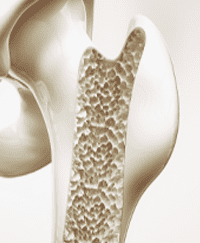 Osteoporosis and Bone Diseases